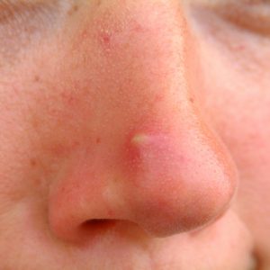 how to get rid of acne with home remedies